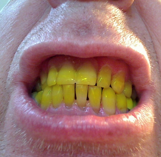 Zähne wieder weiß bekommen
